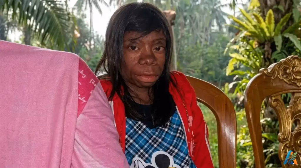 Seftiani, Gadis Berwajah Monyet