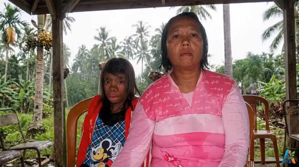 Foto potret ibu dan anak, Seftiani, gadis Indonesia dengan kondisi kraniofasial unik, duduk bersama di bawah pendopo dengan latar kebun kelapa.
