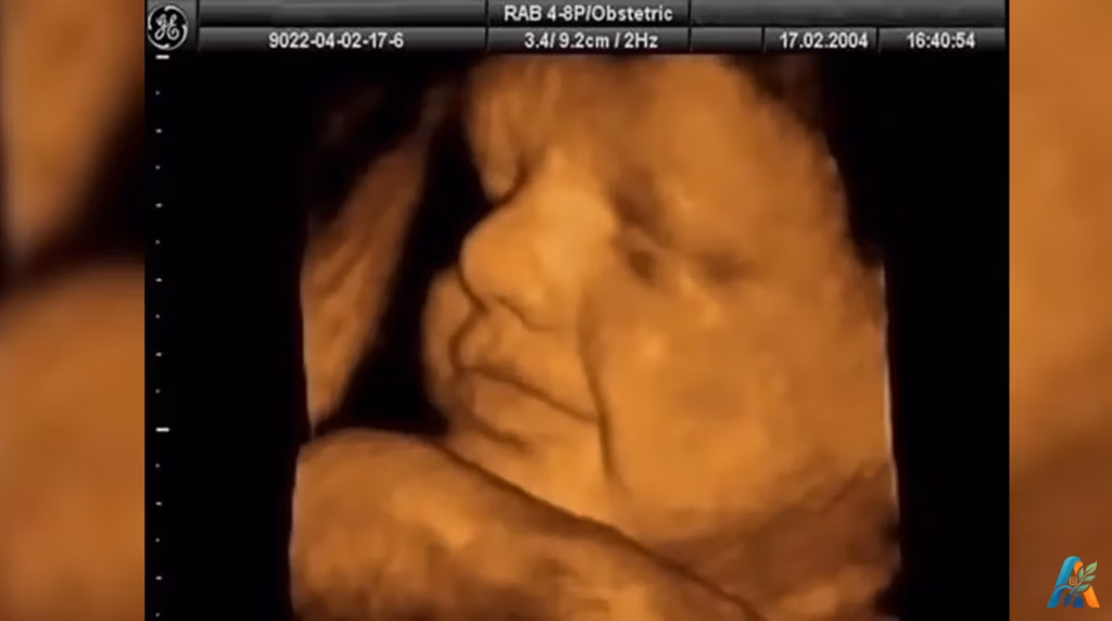Hasil pemindaian USG 3D janin yang memperlihatkan profil wajah bayi dengan jelas di dalam rahim selama masa kehamilan.